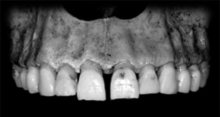 Ridge alterations after tooth extraction